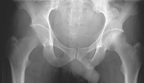 Hip & Knee Reconstruction 2007 Practice Questions: Set 3 (Solved) - Figure 11