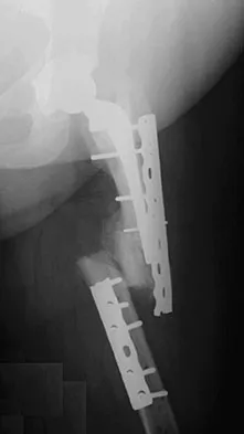 Hip & Knee Reconstruction 2007 Practice Questions: Set 3 (Solved) - Figure 15