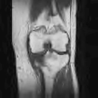 Hip & Knee Reconstruction 2007 Practice Questions: Set 3 (Solved) - Figure 17