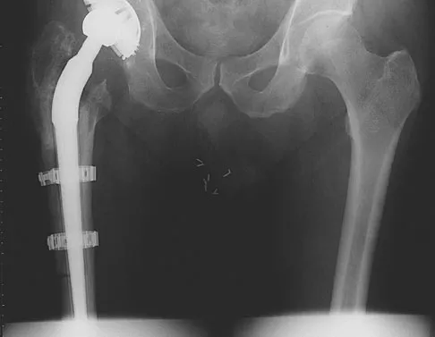 Hip & Knee Reconstruction 2007 Practice Questions: Set 3 (Solved) - Figure 19