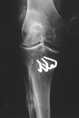 Hip & Knee Reconstruction 2007 Practice Questions: Set 3 (Solved) - Figure 8