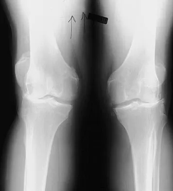 AAOS Orthopedic MCQs (Set 4): Hip & Knee Reconstruction | Board Review Questions