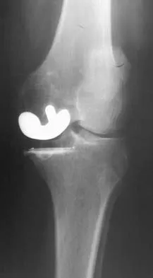 Hip & Knee Reconstruction Board Review 2007: High-Yield MCQs (Set 4) - Figure 11