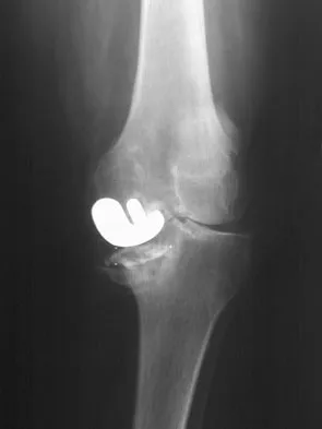 Hip & Knee Reconstruction Board Review 2007: High-Yield MCQs (Set 4) - Figure 12