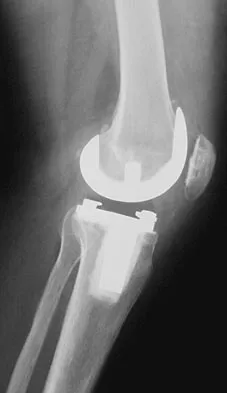 Hip & Knee Reconstruction Board Review 2007: High-Yield MCQs (Set 4) - Figure 19