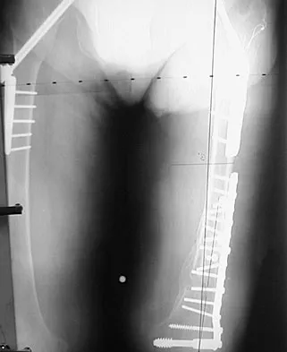 Hip & Knee Reconstruction Board Review 2007: High-Yield MCQs (Set 4) - Figure 4