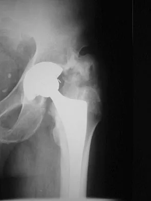 Hip & Knee Reconstruction Board Review 2007: High-Yield MCQs (Set 4) - Figure 8