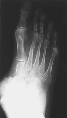 Orthopedic Surgery Board Review 2026 | High-Yield MCQs - Set 1 - Figure 32