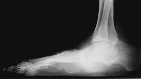 Orthopedic Surgery Board Review 2026 | High-Yield MCQs - Set 1 - Figure 33
