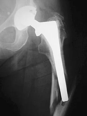 Orthopedic Surgery Board Review 2026 | High-Yield MCQs - Set 1 - Figure 39