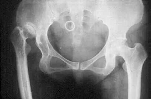 Orthopedic Surgery Board Review 2026 | High-Yield MCQs - Set 1 - Figure 42