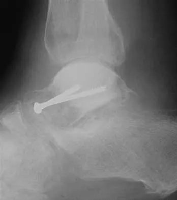 Orthopedic Surgery Board Review 2026 | High-Yield MCQs - Set 1 - Figure 82