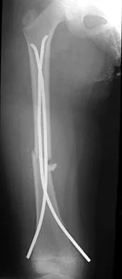 Orthopedic Surgery Board Review 2026 | High-Yield MCQs - Set 10 - Figure 19