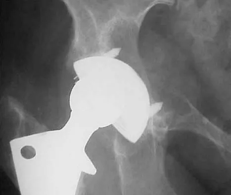 Orthopedic Surgery Board Review 2026 | High-Yield MCQs - Set 2 - Figure 100