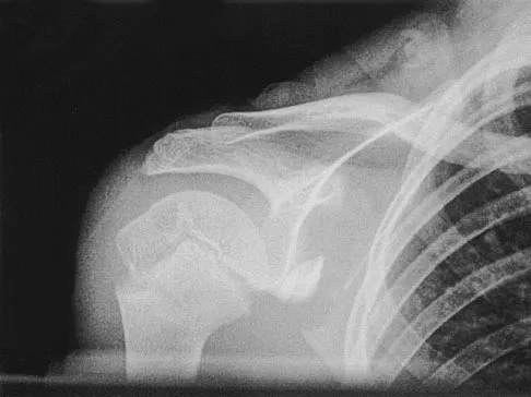 Orthopedic Surgery Board Review 2026 | High-Yield MCQs - Set 2 - Figure 107