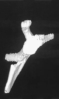 Orthopedic Surgery Board Review 2026 | High-Yield MCQs - Set 2 - Figure 109