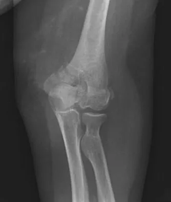 Orthopedic Surgery Board Review 2026 | High-Yield MCQs - Set 2 - Figure 17