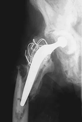 Orthopedic Surgery Board Review 2026 | High-Yield MCQs - Set 2 - Figure 69