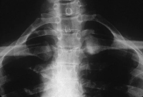 Orthopedic Surgery Board Review 2026 | High-Yield MCQs - Set 2 - Figure 75