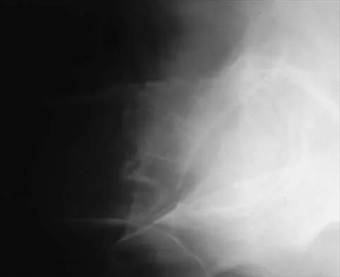 Orthopedic Surgery Board Review 2026 | High-Yield MCQs - Set 2 - Figure 83