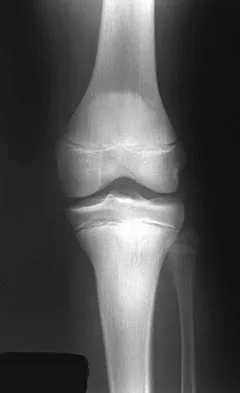 Orthopedic Surgery Board Review 2026 | High-Yield MCQs - Set 2 - Figure 84