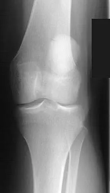 Orthopedic Surgery Board Review 2026 | High-Yield MCQs - Set 2 - Figure 93