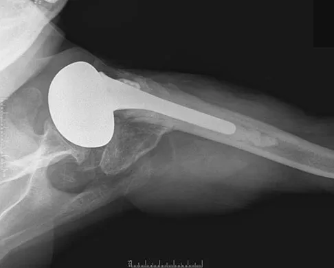 Orthopedic Surgery Board Review 2026 | High-Yield MCQs - Set 2 - Figure 94