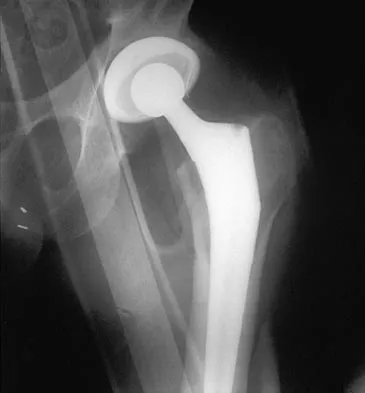 Orthopedic Surgery Board Review 2026 | High-Yield MCQs - Set 3 - Figure 31