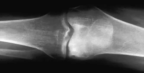 Orthopedic Surgery Board Review 2026 | High-Yield MCQs - Set 3 - Figure 33