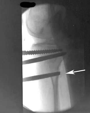 Orthopedic Surgery Board Review 2026 | High-Yield MCQs - Set 3 - Figure 38
