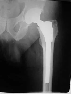 Orthopedic Surgery Board Review 2026 | High-Yield MCQs - Set 3 - Figure 65