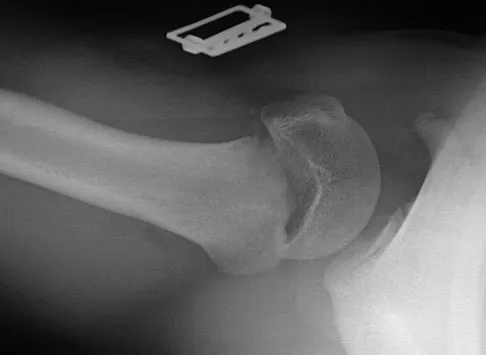 Orthopedic Surgery Board Review 2026 | High-Yield MCQs - Set 3 - Figure 69