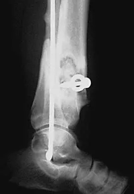 Orthopedic Surgery Board Review 2026 | High-Yield MCQs - Set 4 - Figure 117