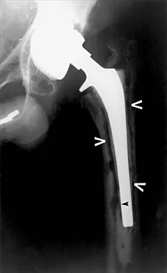 Orthopedic Surgery Board Review 2026 | High-Yield MCQs - Set 4 - Figure 13