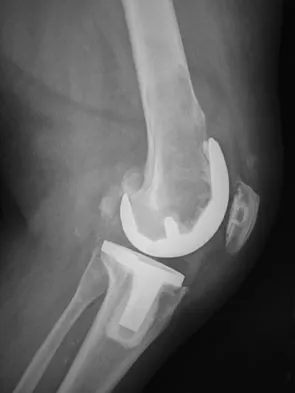 Orthopedic Surgery Board Review 2026 | High-Yield MCQs - Set 4 - Figure 95