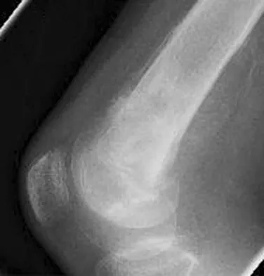 Orthopedic Surgery Board Review 2026 | High-Yield MCQs - Set 5 - Figure 63