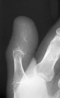 Orthopedic Surgery Board Review 2026 | High-Yield MCQs - Set 6 - Figure 39