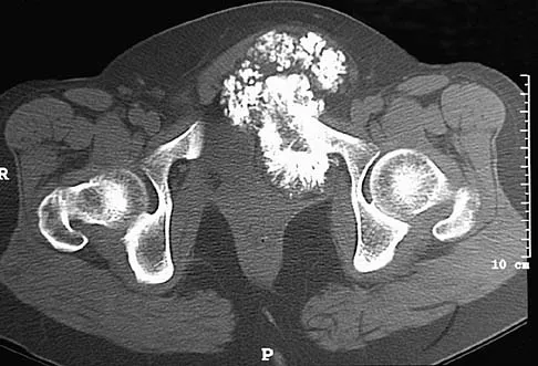 Orthopedic Surgery Board Review 2026 | High-Yield MCQs - Set 6 - Figure 53