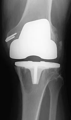 Orthopedic Surgery Board Review 2026 | High-Yield MCQs - Set 8 - Figure 27