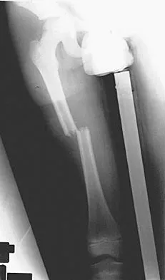 Orthopedic Surgery Board Review 2026 | High-Yield MCQs - Set 8 - Figure 84