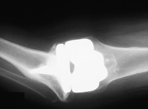 Orthopedic Surgery Board Review 2026 | High-Yield MCQs - Set 8 - Figure 89