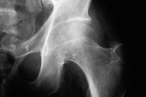 AAOS Spine Orthopedic MCQs (Set 1): Isthmic Spondylolisthesis & Lumbar Disk Herniation | ABOS Board Review