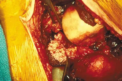 Orthopedic Surgery Board Review 2026 | High-Yield MCQs - Set 9 - Figure 87