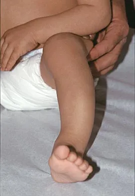 Pediatrics 2004 Practice Questions: Set 1 (Solved) - Figure 24