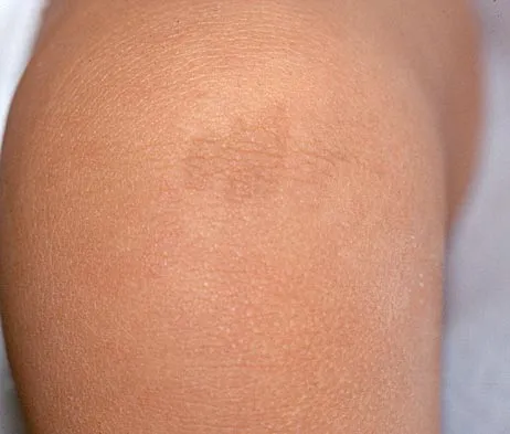 Click to enlarge Pediatrics Board Review 2004: High-Yield MCQs (Set 2) - Figure 22