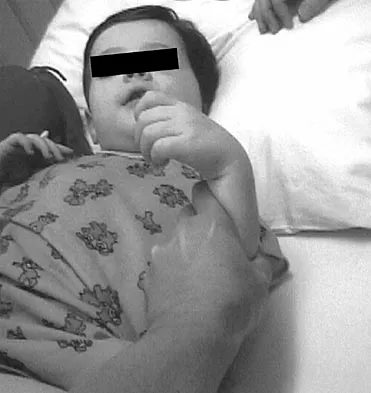 Pediatrics 2004 Practice Questions: Set 3 (Solved) - Figure 18