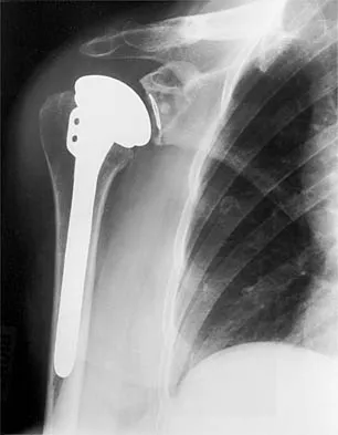 Shoulder 2002 Practice Questions: Set 1 (Solved) - Figure 22