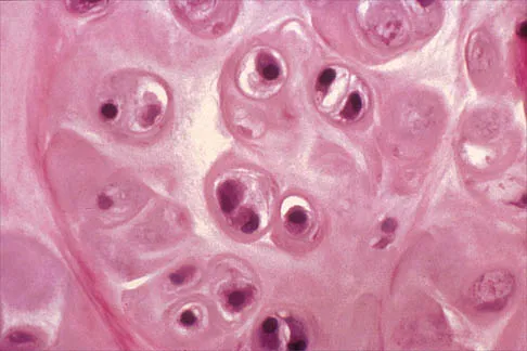 Shoulder Board Review 2002: High-Yield MCQs (Set 2) - Figure 14