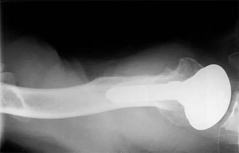 Shoulder Board Review 2002: High-Yield MCQs (Set 2) - Figure 6