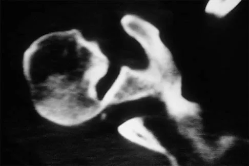 Shoulder Board Review 2002: High-Yield MCQs (Set 4) - Figure 3